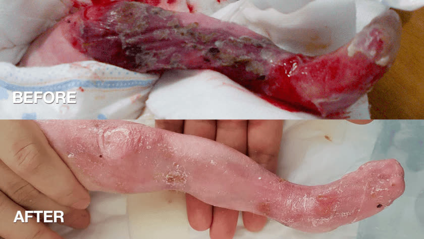 Baby John's leg before and after treatment funded by donations